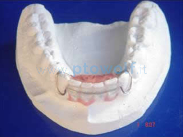 Spring Retainer Inferiore Cset Up Progresso Tecnico Orthodontico